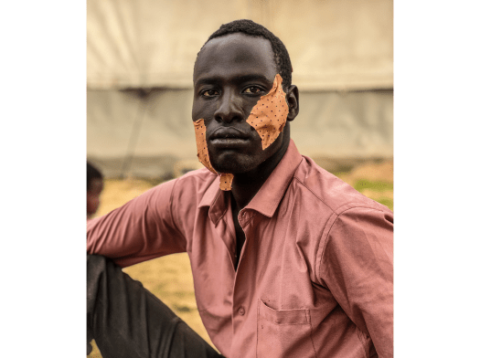 A young man from Sudan with bandages on his face after fleeing El Geneina to Chad.